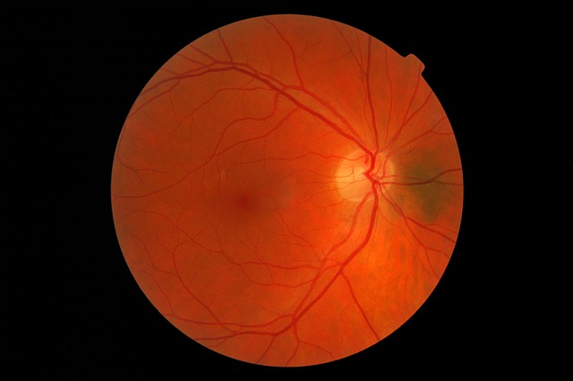 Degeneración Macular